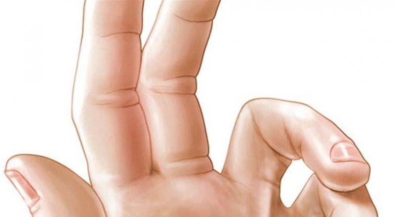 تشوه يصيب اليد ويعيق ممارسة الأنشطة.. اليكم التفاصيل
