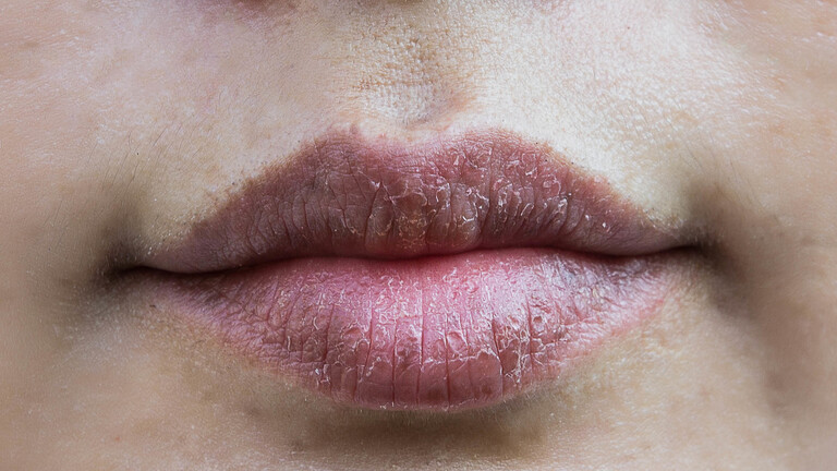 الشفاه الجافة أو المتشققة قد تشير إلى الإصابة بحالة صحية قاتلة