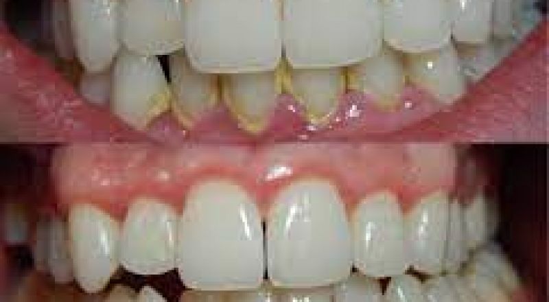 كيف يؤثر التهاب اللثة على الدماغ وهل يسبب الزهايمر؟